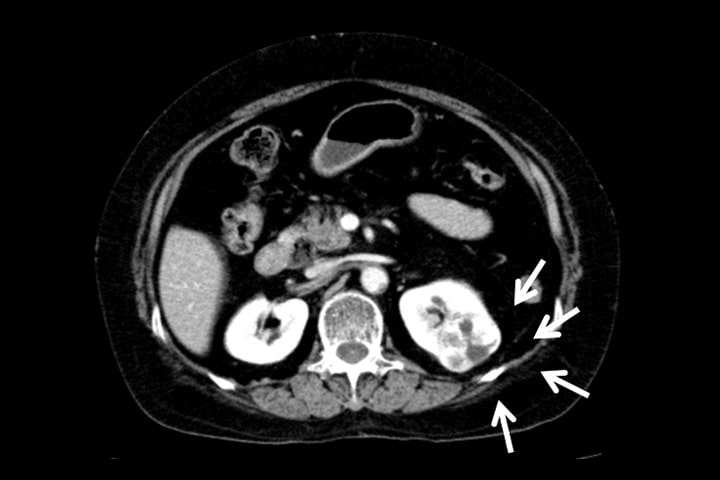腹部CT 腎細胞癌