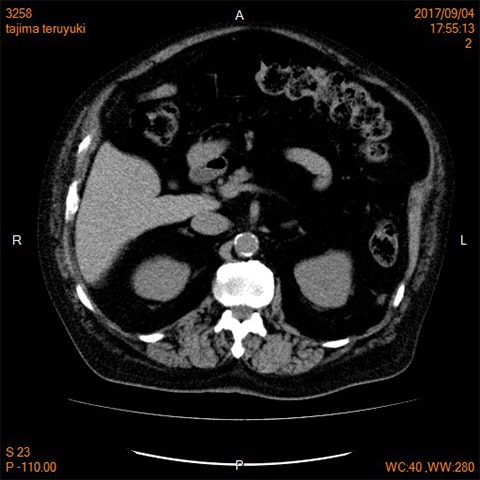 腹部CT検査
